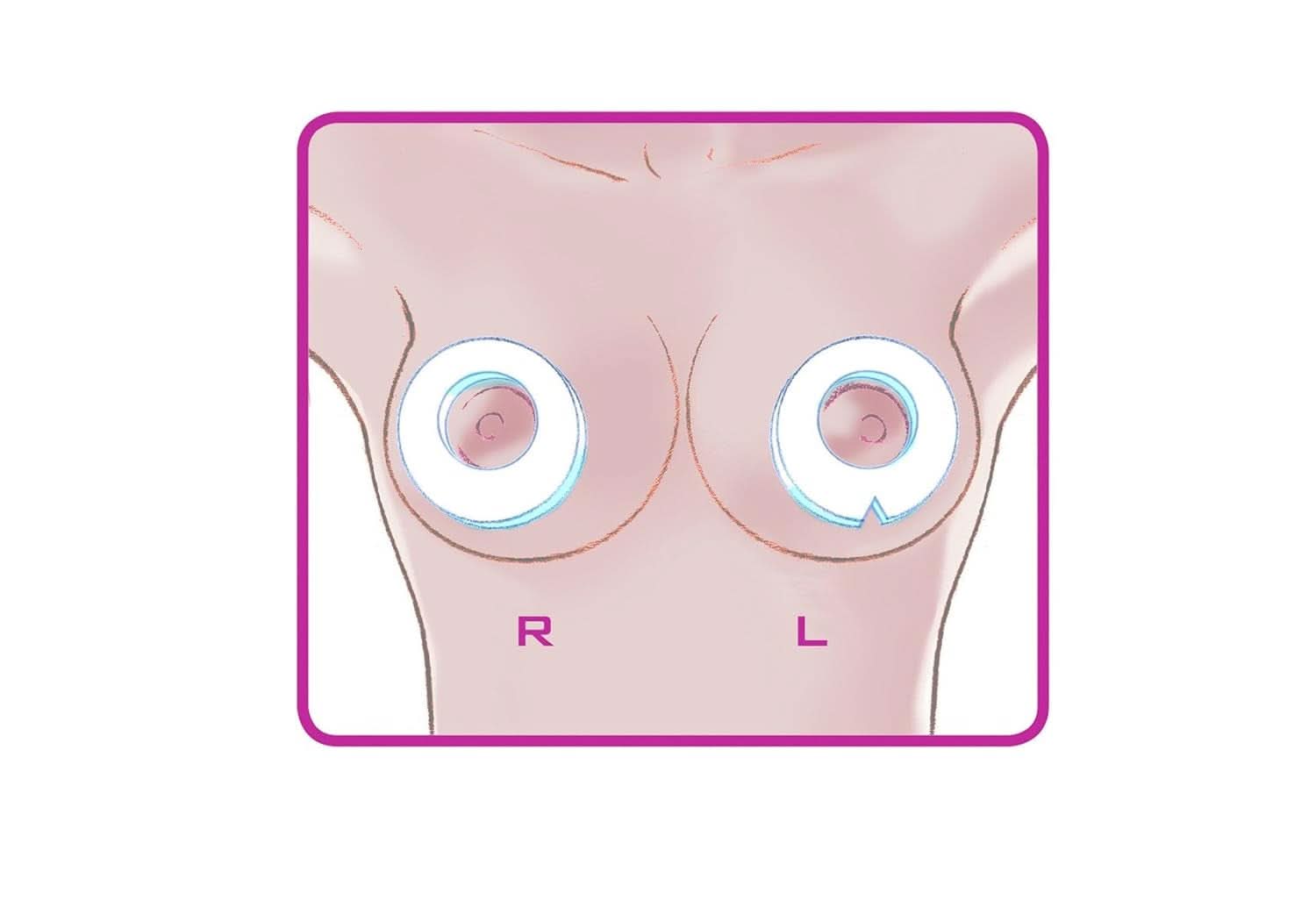 ELANEE Brust-Ringe, Schutz Der Brustwarze Bh-Kontakt Durch Hohllagerung, Ideal Bei Wunden, Entzündeten Brustwarzen Durch Stillen, 10 Stück (222-00) Kiegészítők Élelmiszerek és szoptatás Bebe Naty Shop