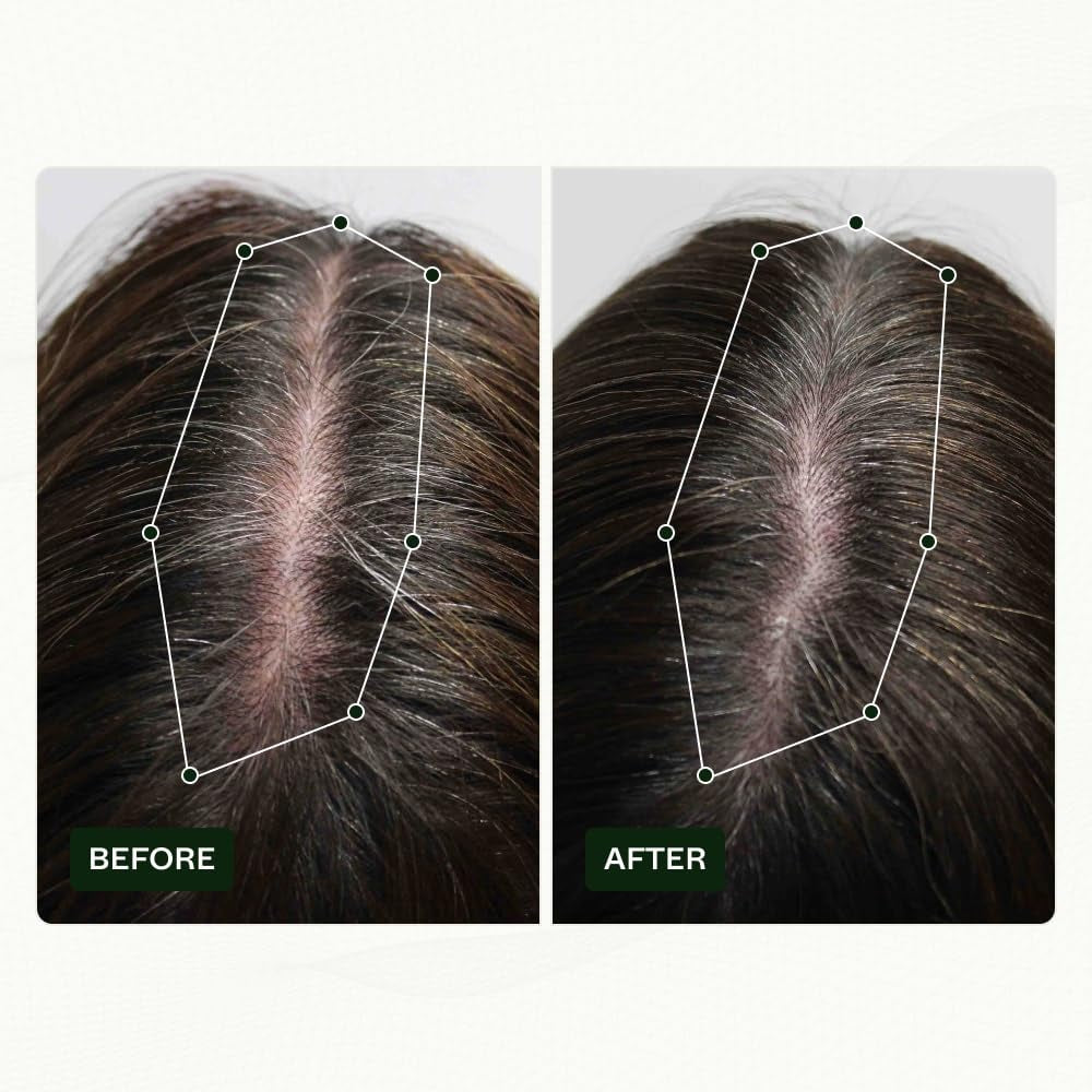 Scandinavian Biolabs Hair Growth Routine pentru femei cu rezultate dovedite clinic în 45 de zile | Tratamentul pentru căderea părului (Bio-Pilixin) Ingrijirea parului Naty Shop